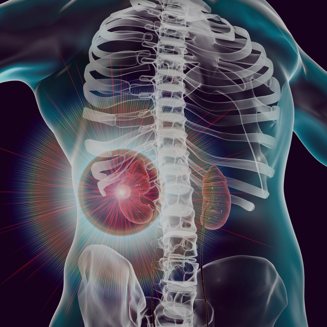 Kidney Failure Workup